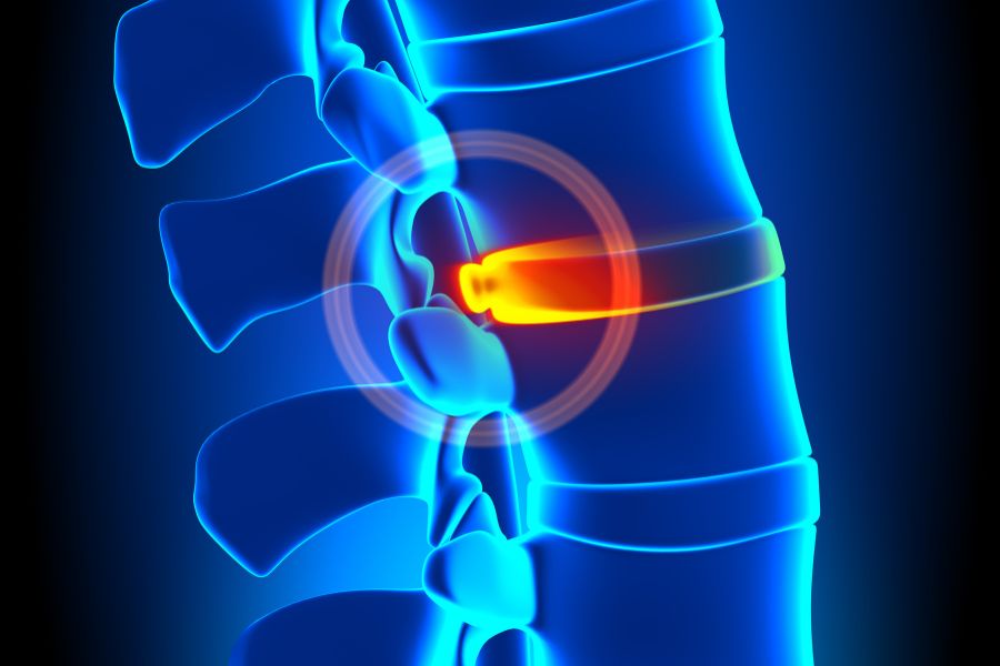 bulging disc recovery time
